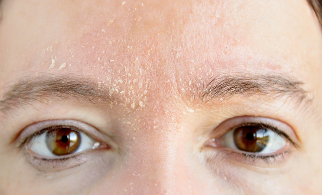 سردی میں ہونے والی ڈرائی اسکن کا مسئلہ کیسے حل کیا جائے؟ ابھی یہ طریقہ آزمائیں اور واضح فرق پائیں