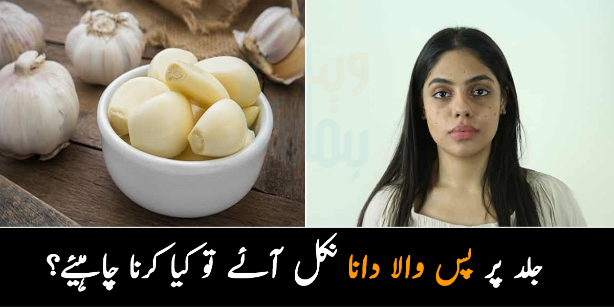 جلد پر پس والا دانا نکل آئے تو کیا کرنا چاہیئے؟ لہسن سے دانوں کو ختم کرکے جلد صاف کرنے کا آسنا طریقہ جانیں اور گھر بیٹھے خوبصورت نظر آئیں