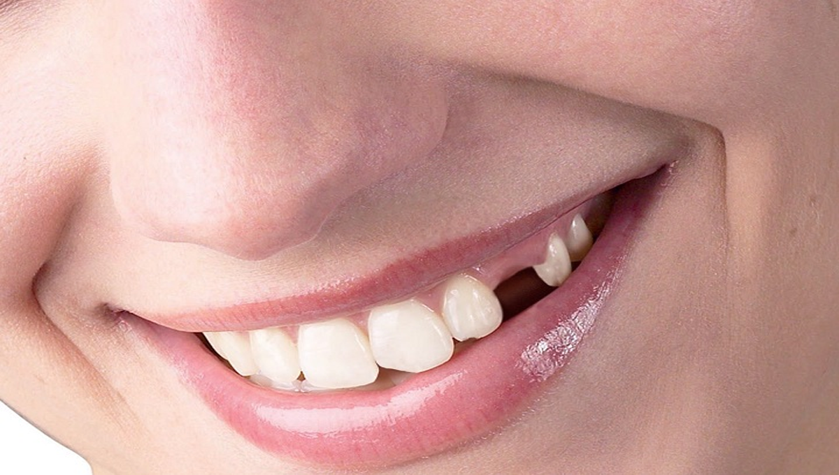 دانت اگانے کا نیا سائنسی طریقہ جس سے نہ ہو شدید تکلیف اور نہ ہو مسوڑوں کا کوئی مسئلہ