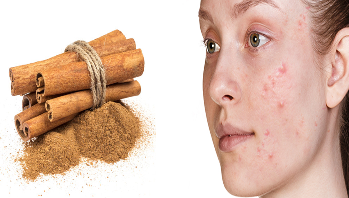 ایکنی سے پریشان ہیں تو استعمال کریں دارچینی اور پائیں چہرے کے داغ دھبوں پر قابو