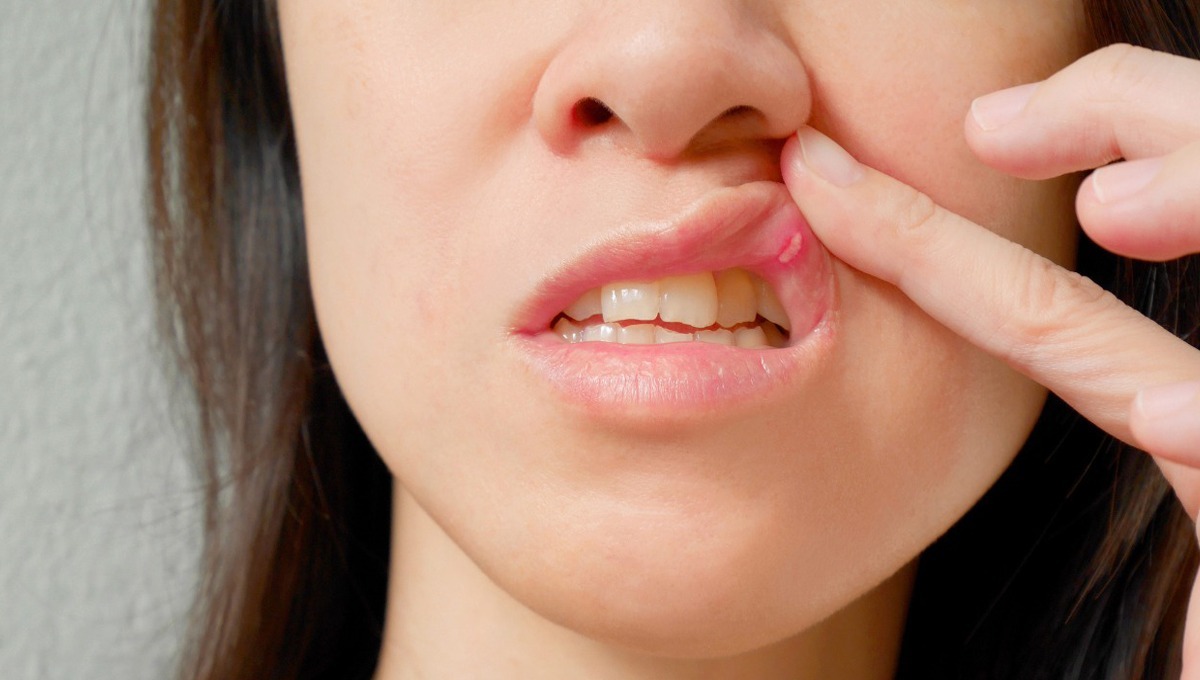 منہ میں چھالے یا زخم ہونے کی وجہ سے پریشان ہیں تو دن میں دو بار پانی میں یہ چیز ملا کر غرارے کریں اور جلد آرام پائیں