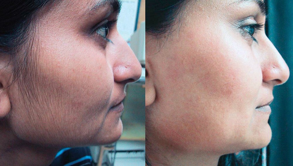 چہرے کے غیر ضروری بالوں سے پریشان ہیں؟ جانیں انہیں ختم کرنے کا ایسا طریقہ جو کر دے آپ کی یہ مشکل آسان