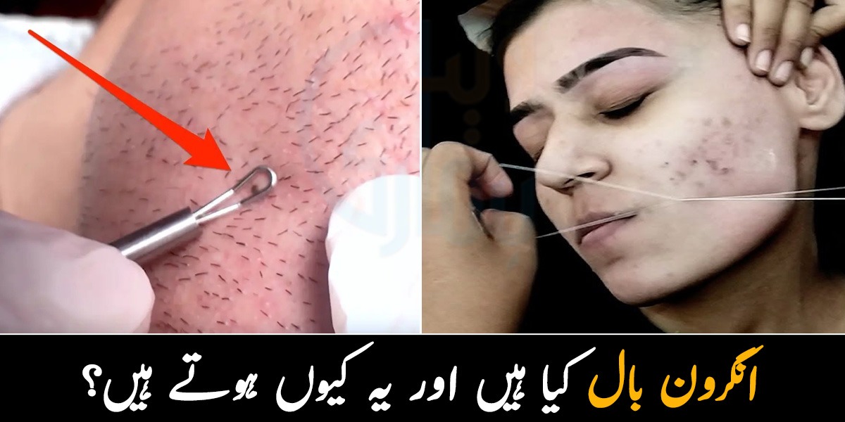 جلد پر نکلنے والے چھوٹے اور موٹے بال ۔۔ یہ بال جلد پر کیوں نکلتے ہیں؟ جانیے ان بالوں کو ختم کرنے کے لیے مشہور ڈاکٹر کی رائے