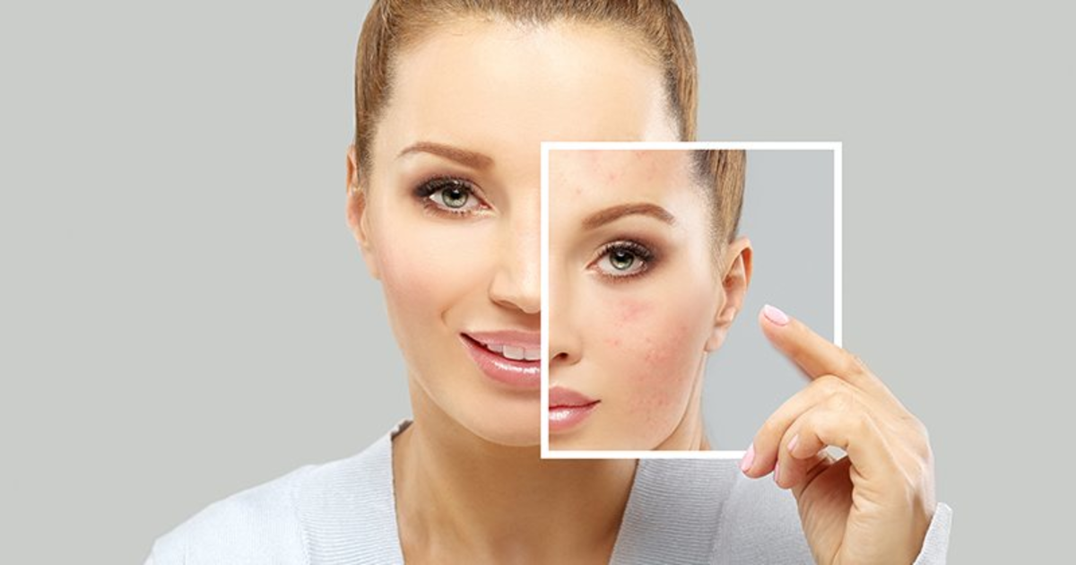 چھائیوں سے نجات کے لئے سب سے آسان اور کم خرچ طریقہ