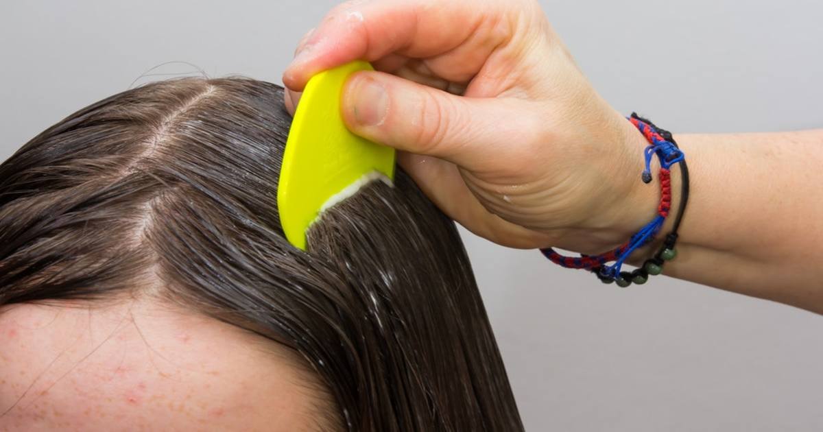 بالوں سے جوؤں کا خاتمہ کرنا چاہتے ہیں تو بس یہ ٹوٹکہ شروع کردیں اور چند دنوں میں جوؤں کے خاتمے کو ممکن بنائیں