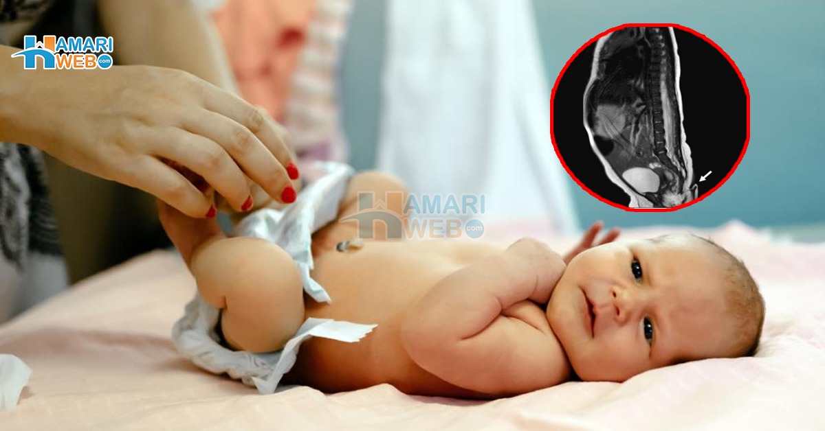 6 سینٹی میٹر لمبی دُم والی انوکھی بچی کی پیدائش، دیکھ والدین اور ڈاکٹر بھی خوفزدہ