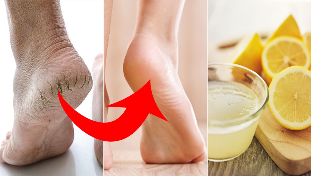 پھٹی ہوئی ایڑھیاں صرف لیموں سے نرم و ملائم بنانے کا آسان طریقہ جانیں