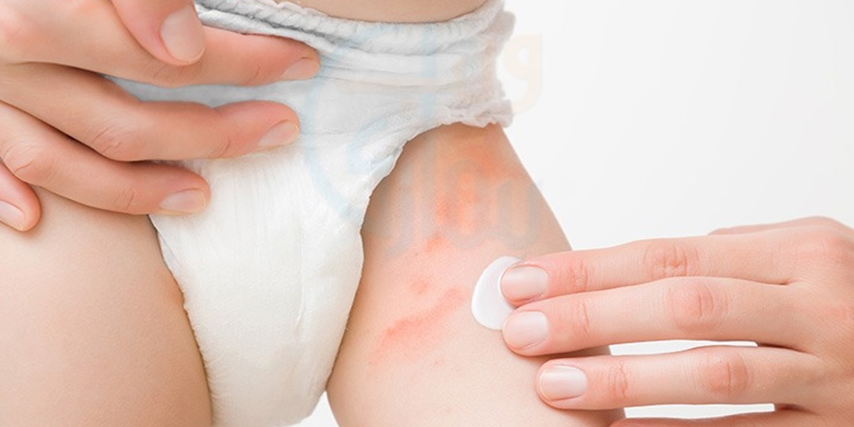 بچوں کے پیمپرز کے ریشز سے پریشان ہیں تو یہ آسان ٹپ آزمائیں جو ماؤں کی بڑی مشکل آسان کرے