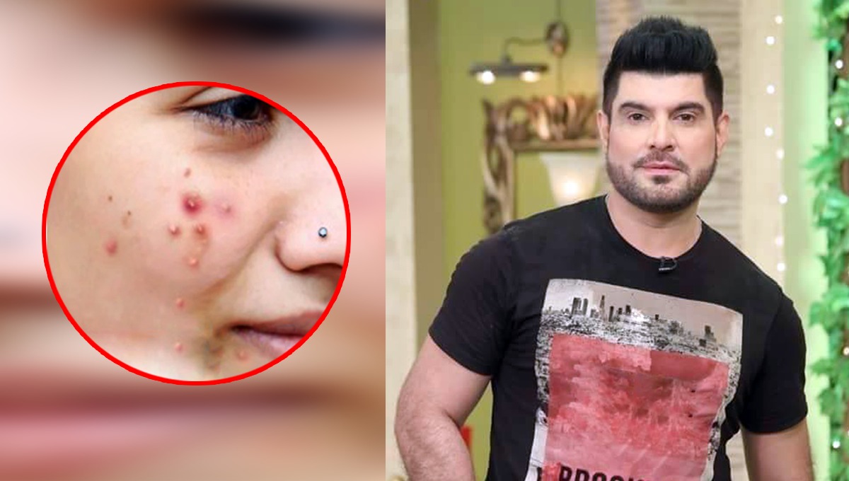 ڈاکٹر خُرم نے بتائی گھر میں بڑھتے ہوئے ایکنی کو کنٹرول کرنے کی آسان ٹپ جو بنائے آپ کے چہرے کو بالکل صاف