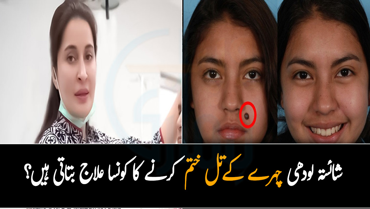 چہرے پر تل کیوں ہوتے ہیں؟ ڈاکٹر شائستہ لودھی ان کو ختم کرنے کا کونسا علاج بتاتی ہیں جس سے یہ بنا کسی تکلیف کے ختم ہو جاتے ہیں