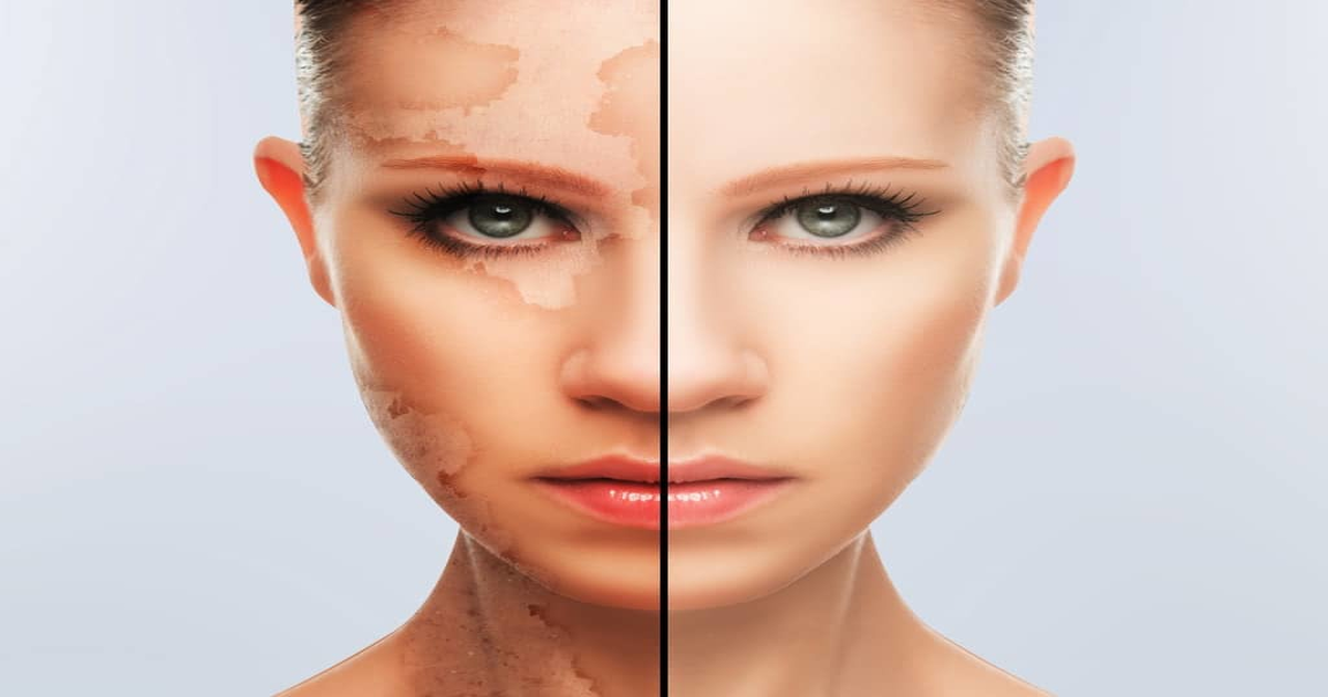 ہلدی سے برص کے داغ کا حیرت انگیز علاج جو برص کو جڑ سے ختم کردے