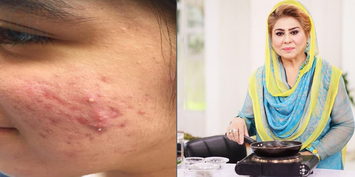ایکنی کوئی بیماری نہیں، جسمانی تبدیلی ہے ۔۔ اگر آپ کو بھی ایسی ایکنی ہوگئی ہے تو جانیئے رانی آپا کا بتایا ہوا نسخہ جو جلد ہی ایکنی کو کرے دور