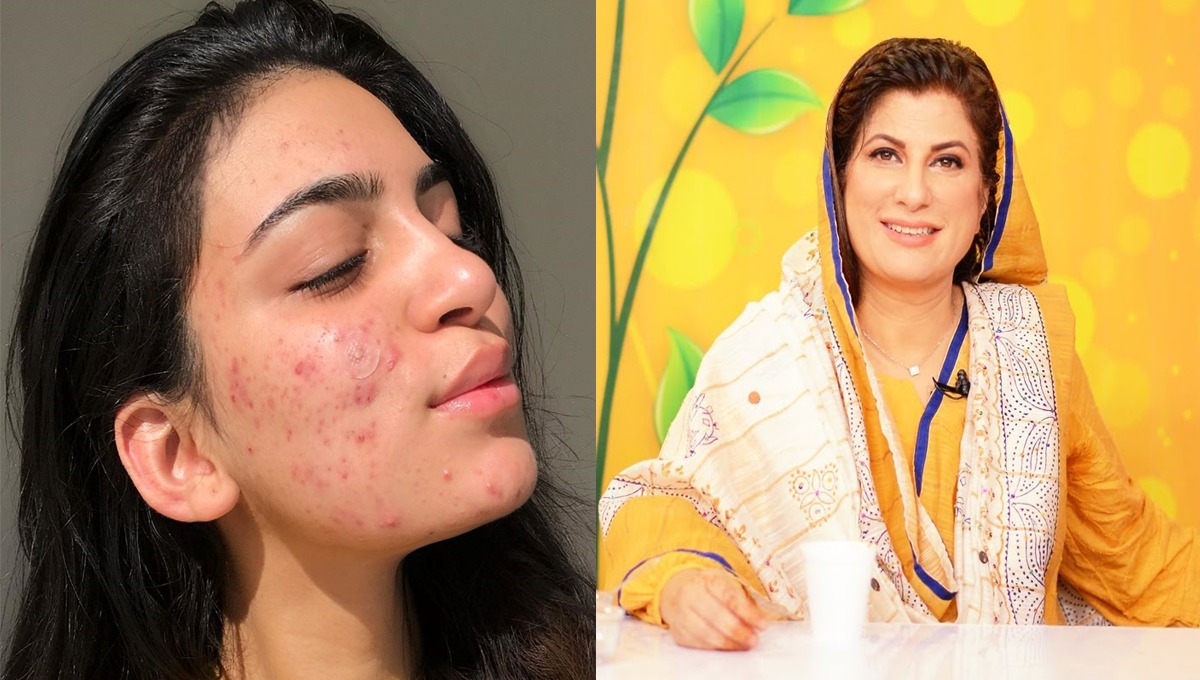 چہرے کے دانوں سے ہمیشہ کے لئے چھٹکارا پائیں، جانیں ڈاکٹر بلقیس کا بتایا ہوا ایسا آزمودہ نسخہ کہ دانے اور اس کے نشانات جلد صاف ہو جائیں گے