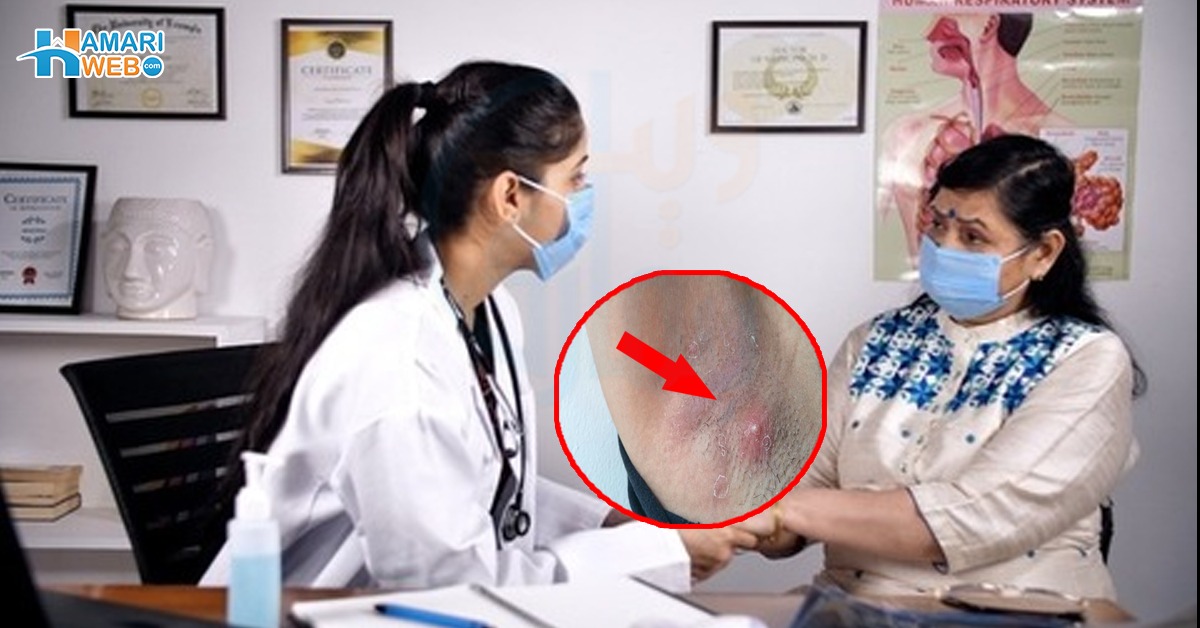 بغل میں پمپلز کیوں ہیں؟ جانئے اسکی وجوہات کیا ہیں اور یہ کون سی بیماریوں کا سبب بن سکتے ہیں