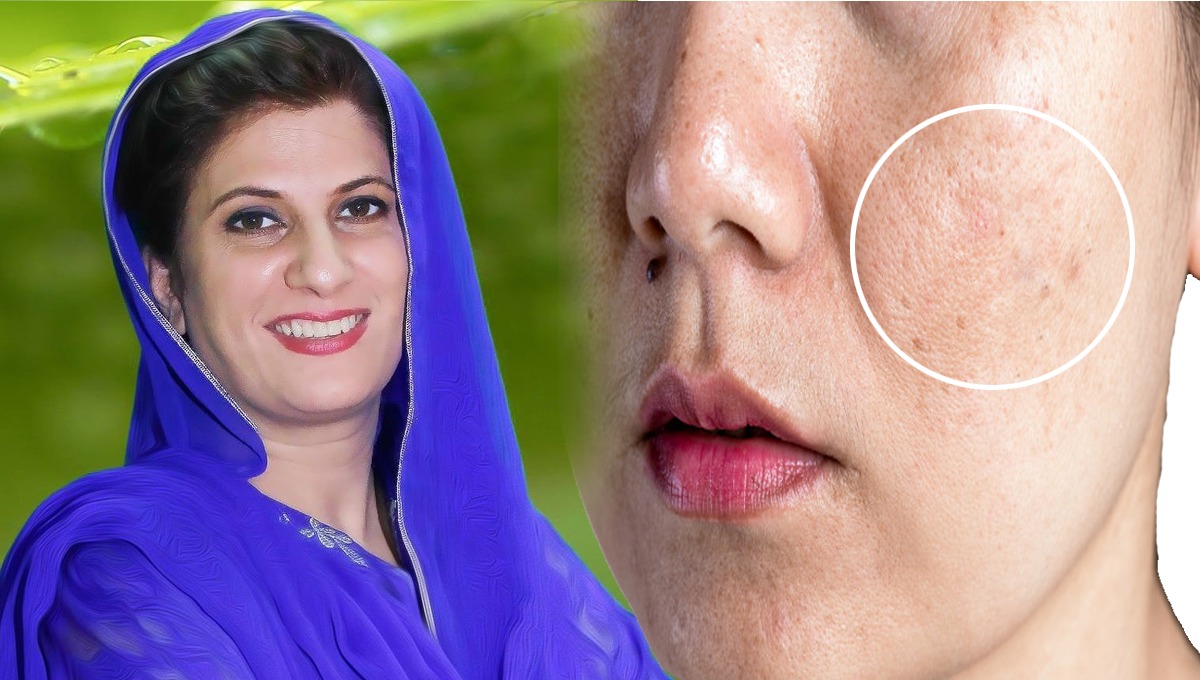 ڈاکٹر بلقیس کا یہ جادوئی نسخہ آزمائیں اور جھائیوں، داغ دھبوں سے نجات پائیں