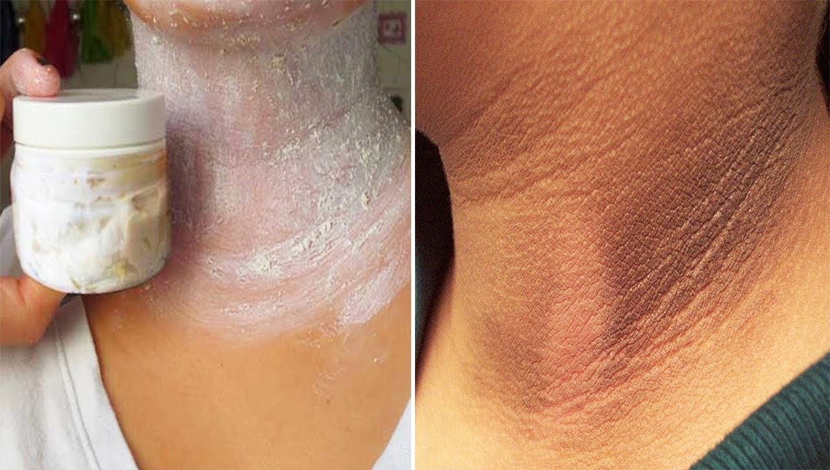 ذرا سا بیکنگ سوڈا بنائے آپ کی گردن کو خوبصورت اور گردن پر موجود کالے نشان پر پائے فوراً قابو