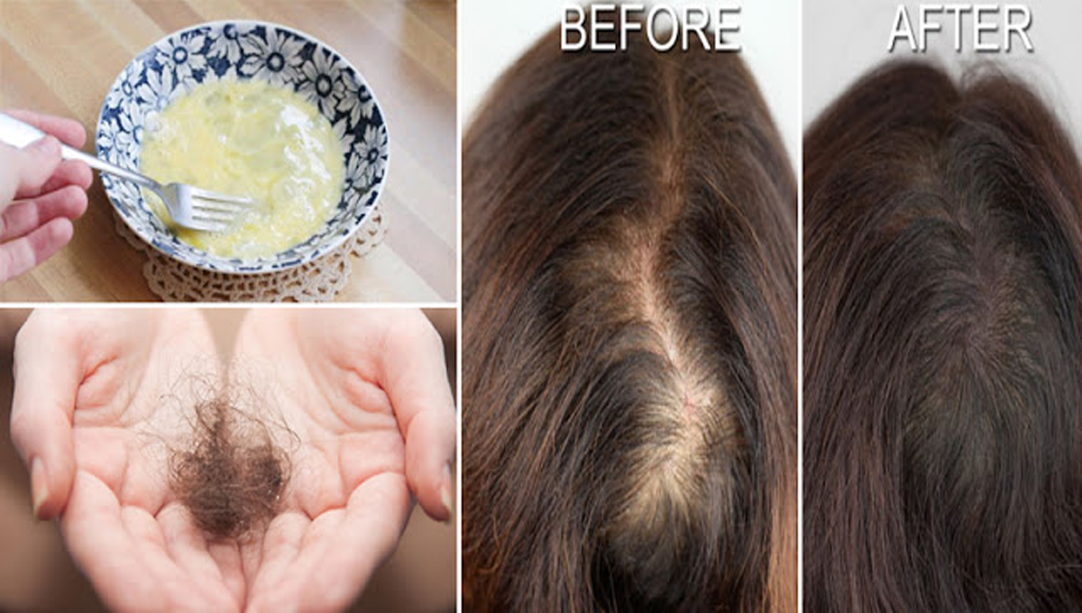 گنچ پن کا علاج کیسے ممکن ہوسکتا ہے؟ جانیں اس سے چھٹکارا پانے کے لیے چند قدرتی اور گھریلو علاج