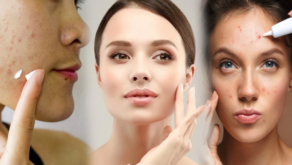 کیا آپ کو معلوم ہے کہ ایکنی کا علاج آپ کے کچن میں موجود ہے؟ آزمائیں اور چہرے میں موجود ایکنی سے چھٹکارا پائیں