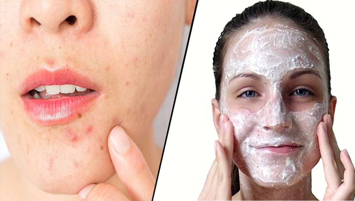عید سے قبل ایکنی فیشل کریں گھر پر موجود ان اجزاﺀ سے تاکہ عید میں ہو چہرہ بالکل صاف اور ایکنی سے مل جائے آپ کو نجات