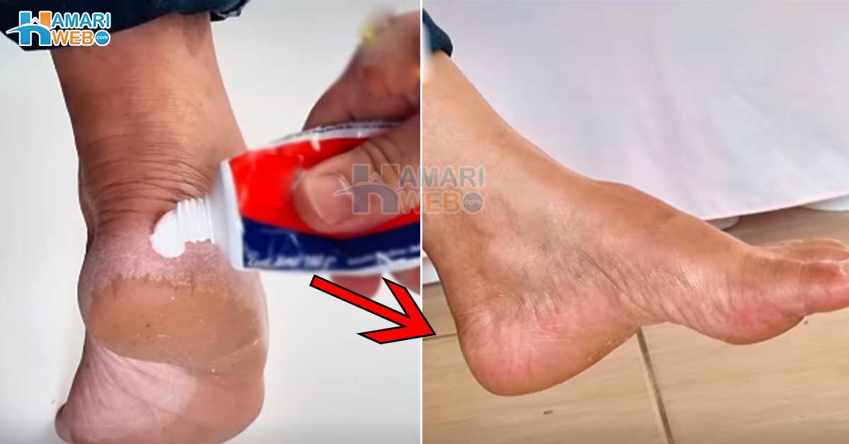 پاؤں کی پھٹی ایڑیاں کیسے ٹھیک کریں؟ جانیں ٹوتھ پیسٹ کی مدد سے پھٹی ہوئی ایڑیوں کو نرم اور خوبصورت بنانے کا طریقہ