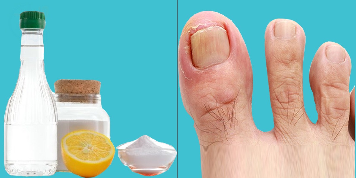 ناخنوں میں فنگس کیوں ہوتا ہے؟ جانیں اس کو گھر میں ختم کرنے کا آسان طریقہ جس سے ملے درد سے جلد نجات اور ہو جائے فنگس ہمیشہ کے لئے غائب