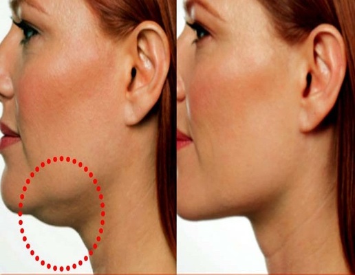 ڈبل چن سے نجات پانے کے7 ٹوٹکے