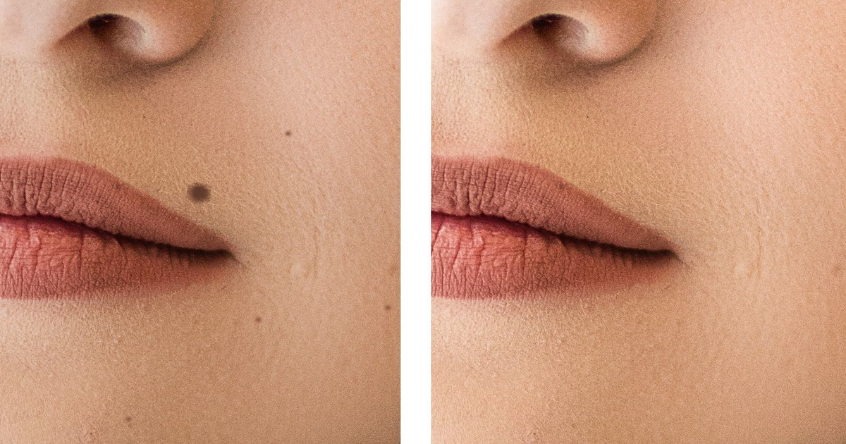 جسم پر سے تل کو باحفاظت ختم کرنے کا طریقہ