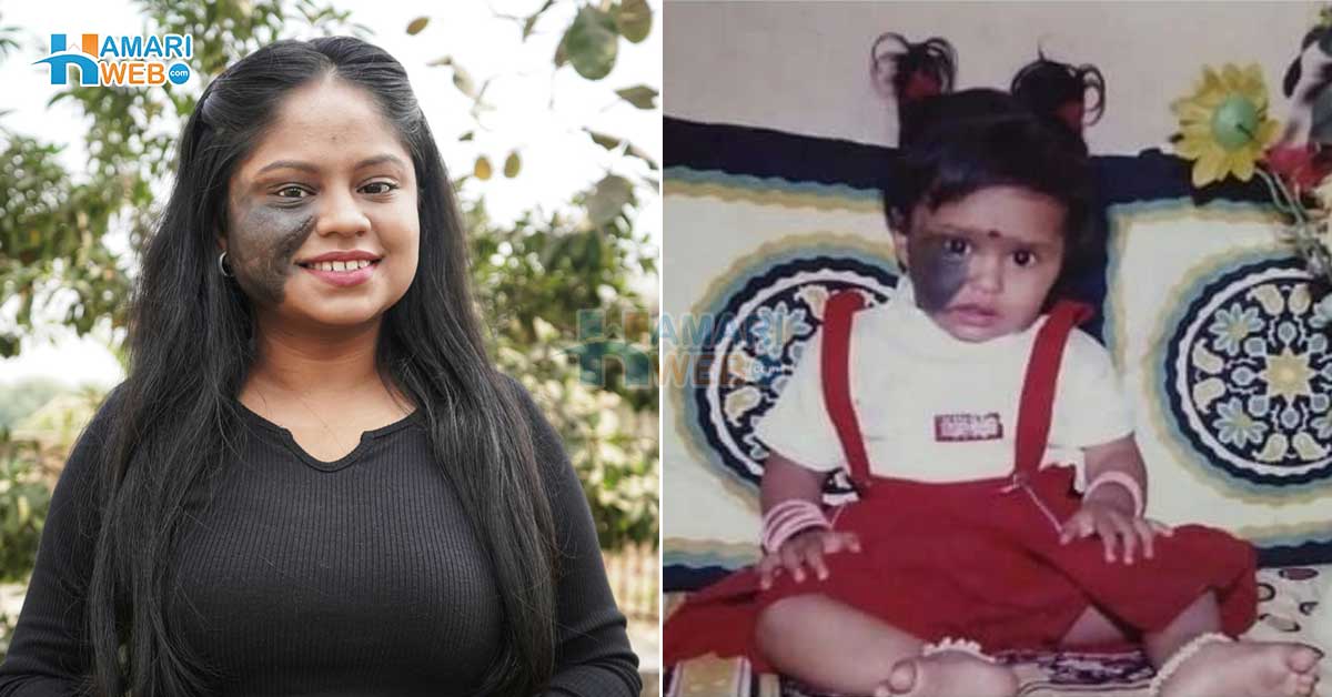 مجھے اس نشان سے نقرت ہوگئی تھی پھر ۔۔ پیدائشی نشان پر لوگوں کی تنقید کا نشانہ بننے والی لڑکی کے ساتھ کیا ہوا پھر؟ ایک بہادر لڑکی کی کہانی